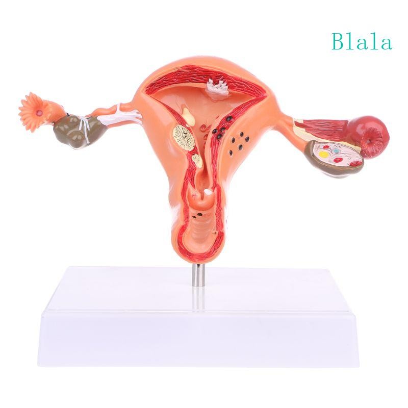 Blala มดลูกทางพยาธิวิทยา Ovary Anatomical Model Anatomical สําหรับเครื่องมือศึกษาส่วนข้าม
