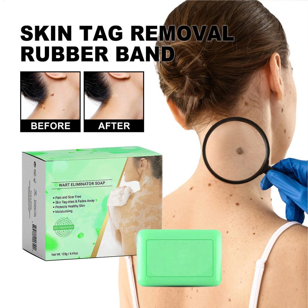 ทั่วไป Wart Remover สบู่ Plantar Wart Remover สบู่สําหรับฟุต Gentle Wart Removal สําหรับผิวแท็กทั่วไ