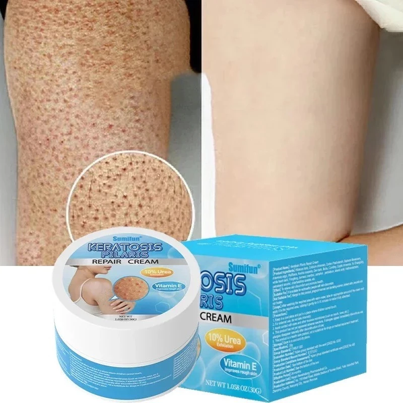 Keratosis Pilaris Repair cream Bumpy Rough Chicken Follicle Skin Repair Strawberry Legs Removal Dry Skin Care