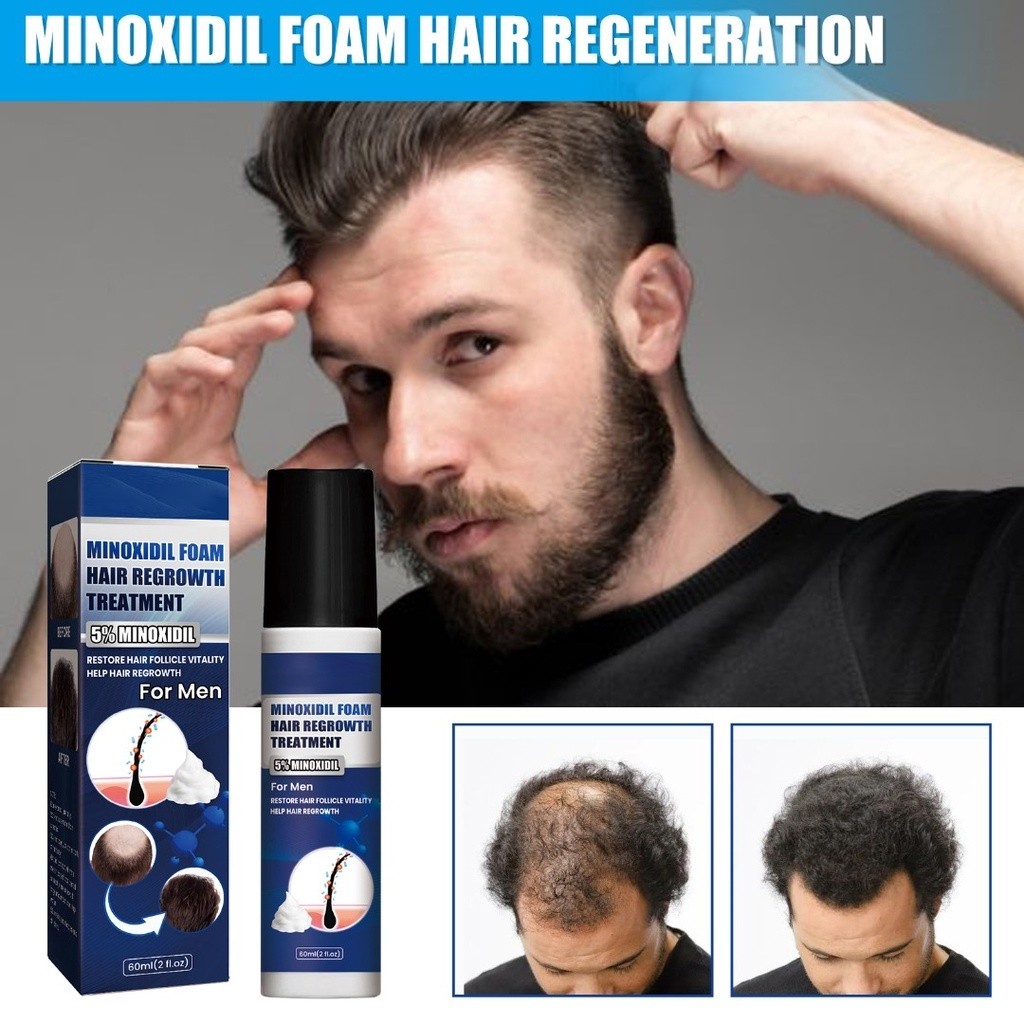 Minoxidil Foam Extra Strength & Biotin Hair Regrowth Treatment for Men