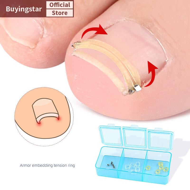 ZCX คุด Toenail Corrector Pedicure กู้คืน Embed Toe Nail Treatment Foot Correction Patch สติกเกอร์ Care เครื่องมือ VO
