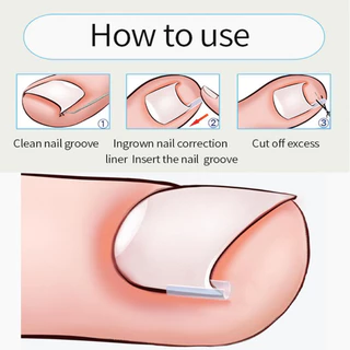 10/20/30 ชิ้นคุด Toenail Corrector - แผ่นรองหลอดรูปตัว C ยืดหยุ่น - รักษาเล็บนิ้วเท้า คลิปยืดร่องที่มองไม่เห็น