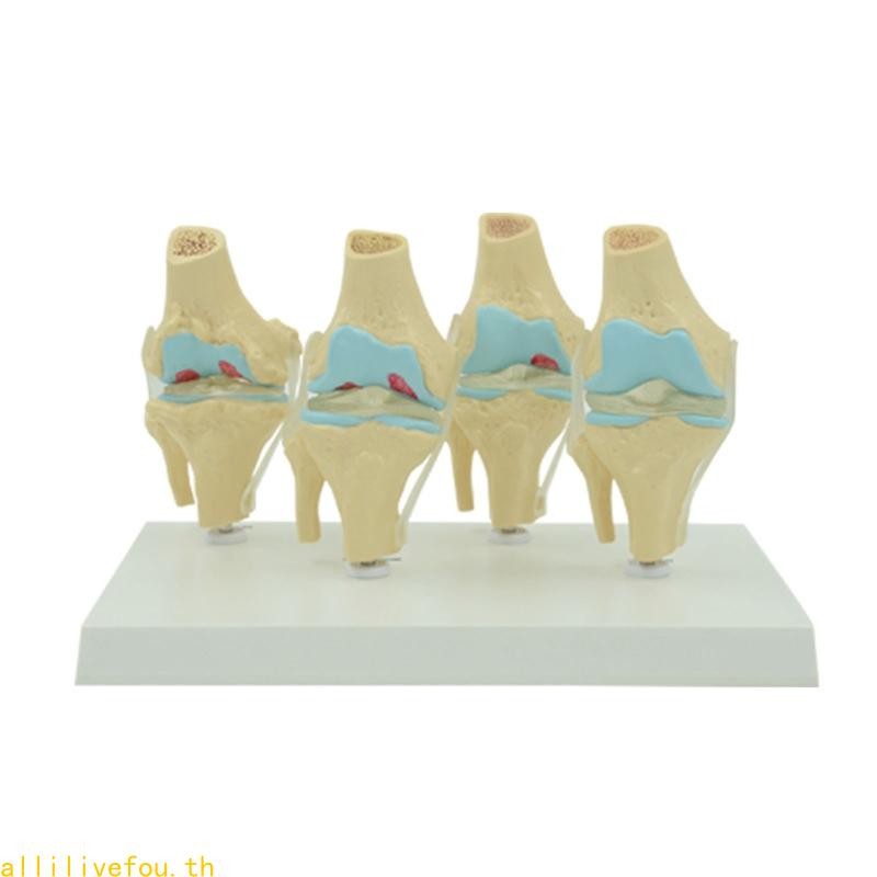 LIVE ยืดหยุ่น Human Knee Joint Anatomy รุ่น Comparison of Knee Joint รุ่น Life Size