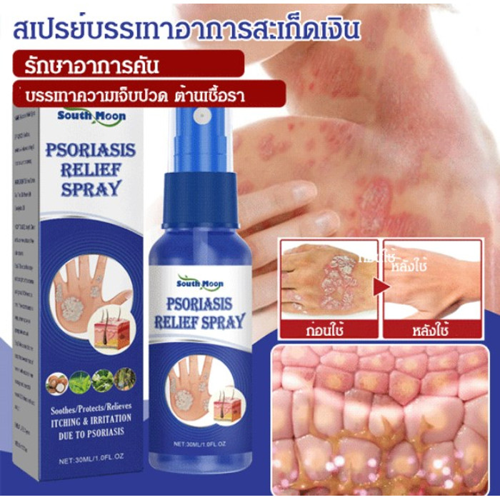 【1/2 PCS】Psoriasis relief spray 【Relieve itchy skin】