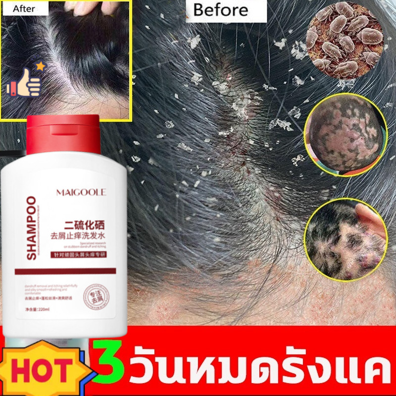 แชมพูคุมมันกำจัดรังแค แชมพูรังแค แชมพูคัน