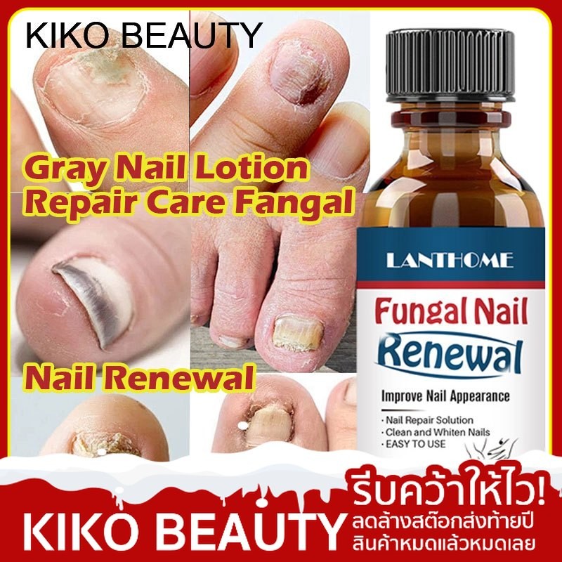 【ลดล้างสต๊อก】 Kiko Beauty ฆ่าเชื้อราที่เล็บ เซรั่มบำรุงเล็บ ยาเชื้อราเล็บ ซรั่มรักษาเล็บ เชื้อราเล็บ ครีมบำรุงเล็บ