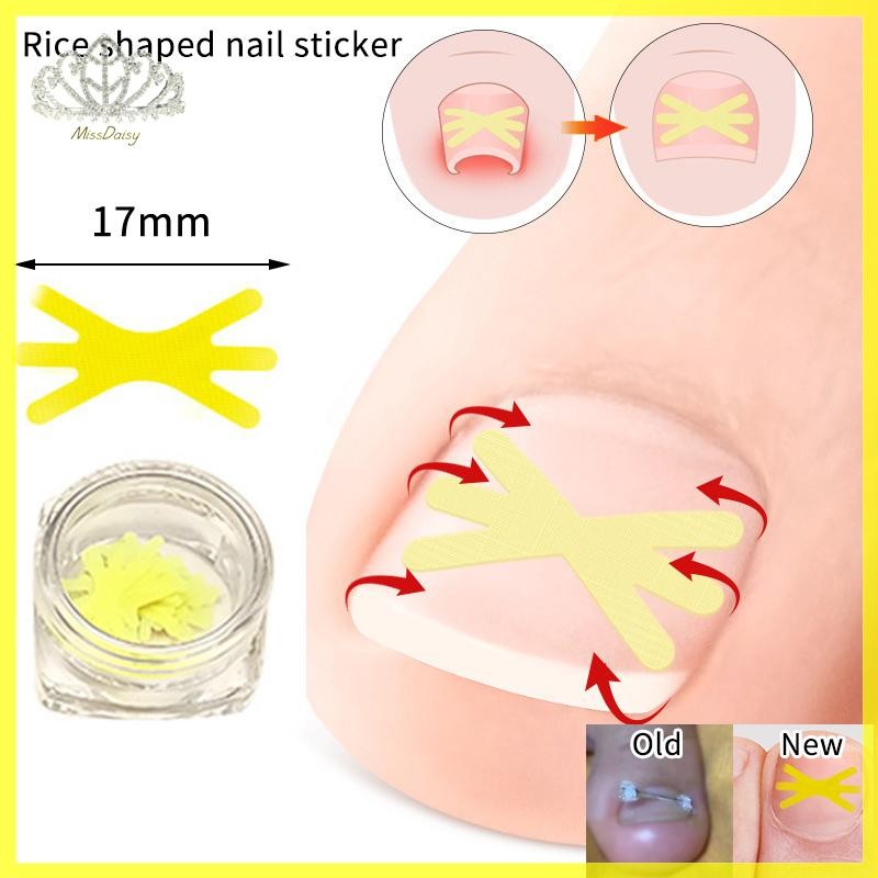 10 ชิ้นรูปร่างใหม่คุดเล็บเท้าแก้ไขคลิป Pedicure Toe เครื่องมือเล็บ Treatment Elastic Straightening คลิปรั้ง TH