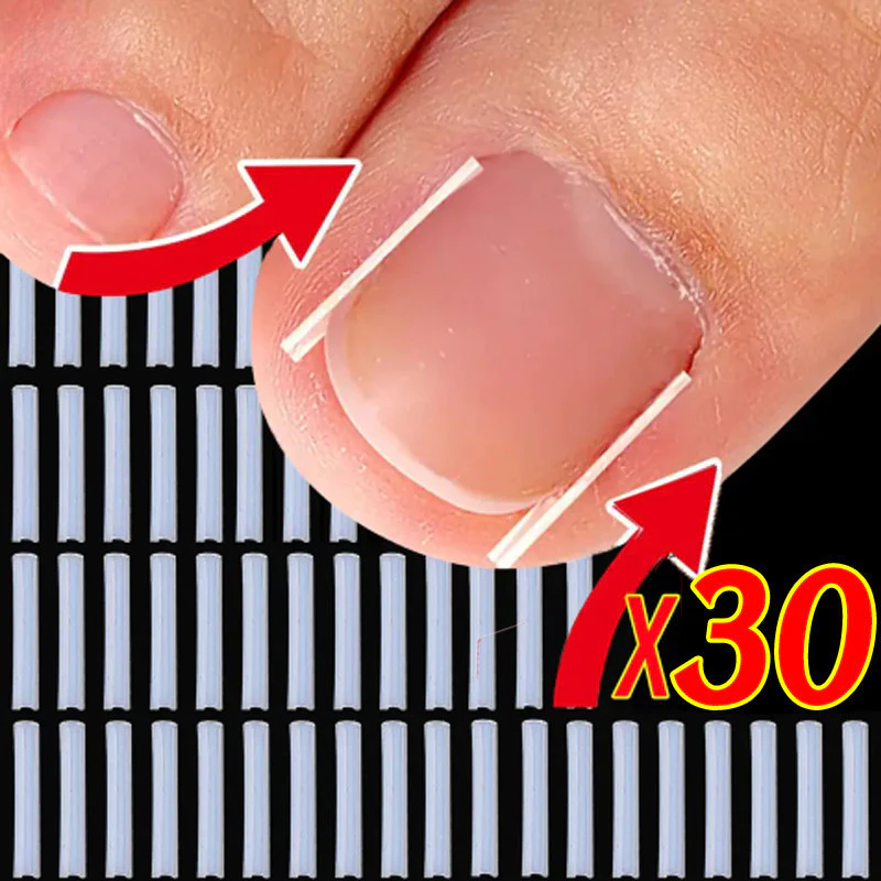 10/20/30 ชิ้นคุด Toenail Corrector - แผ่นรองหลอดรูปตัว C ยืดหยุ่น - รักษาเล็บนิ้วเท้า คลิปยืดร่องที่มองไม่เห็น