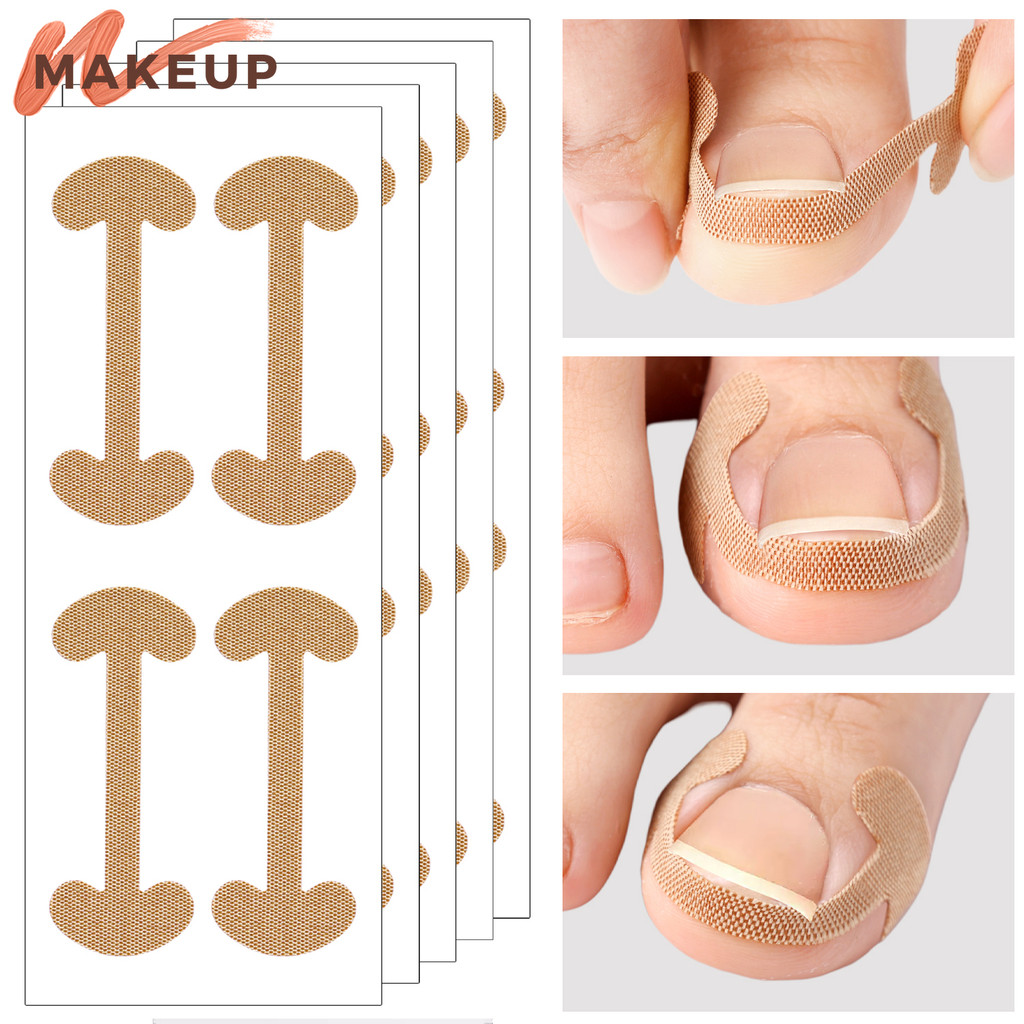 เครื่องมือทําเล็บเท้าดูแลนิ้วเท้า - แถบแก้ไขเล็บ - 100 ชิ้นสติกเกอร์แก้ไขเล็บเท้าคุด - แผ่นแปะรักษาเล็บป้องกันการติดเชื้อ - การยึดเกาะยาวนาน, กันน้ํา, ระบายอากา