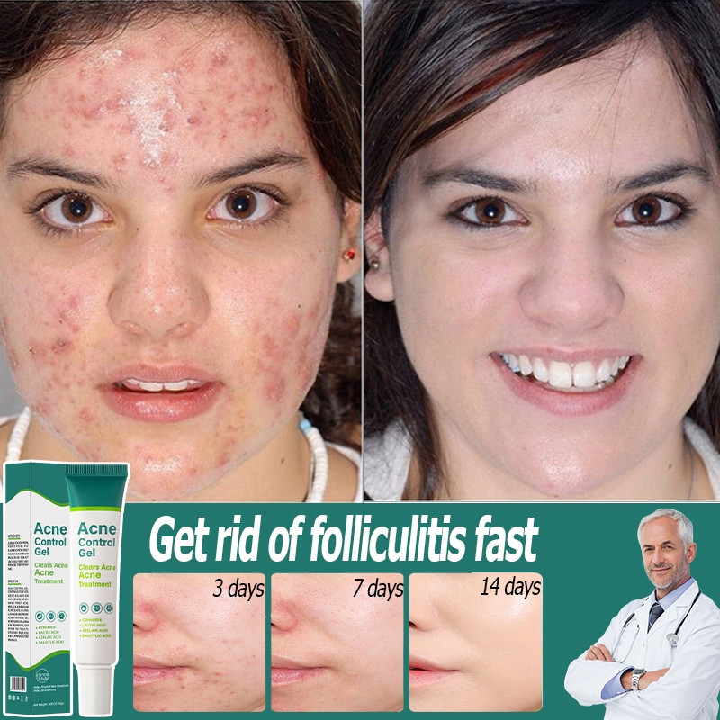 7BIH Acne Pimple Mark Remover สําหรับสิว Spot Treatment Acne Scar Remover Acne Remover 20ml