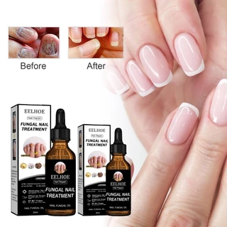 EELHOE 50ml น้ำยารักษาเชื้อราที่เล็บ น้ำยาซ่อมแซมเล็บเหลือง ซ่อมแซมเล็บแตก น้ำยารักษาเล็บ