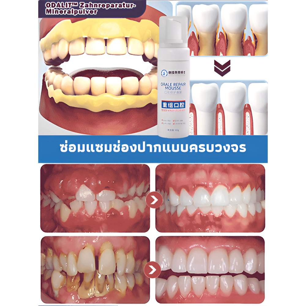 【ผ่านการทดสอบทางการแพทย์】SL มูสฟื้นฟูช่องปากเร่งด่วน รักษาแผลในปาก/มูสสําหรับช่องปาก/สูตรทางการแพทย์ ราคา ถูกที่สุด ดีลบีเคเค แกลเลอรีภาพที่ 4