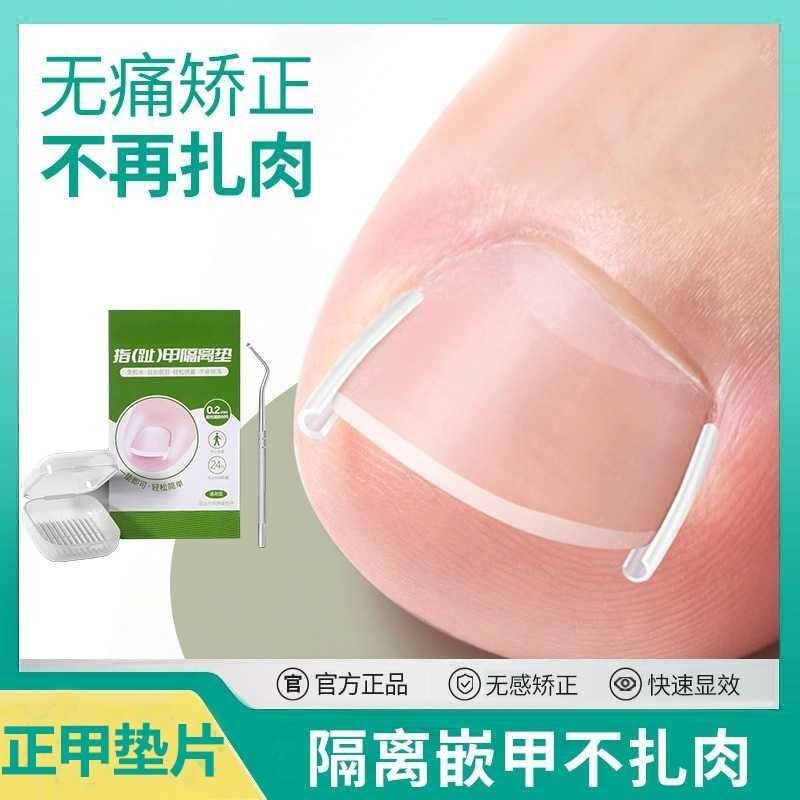 Paronychia แก้ไขสิ่งประดิษฐ์เล็บ corrector สําหรับจุดสูงสุดและเชื้อราเฉพาะจุดจุดสูงสุดจุดสูงสุดหรือถ