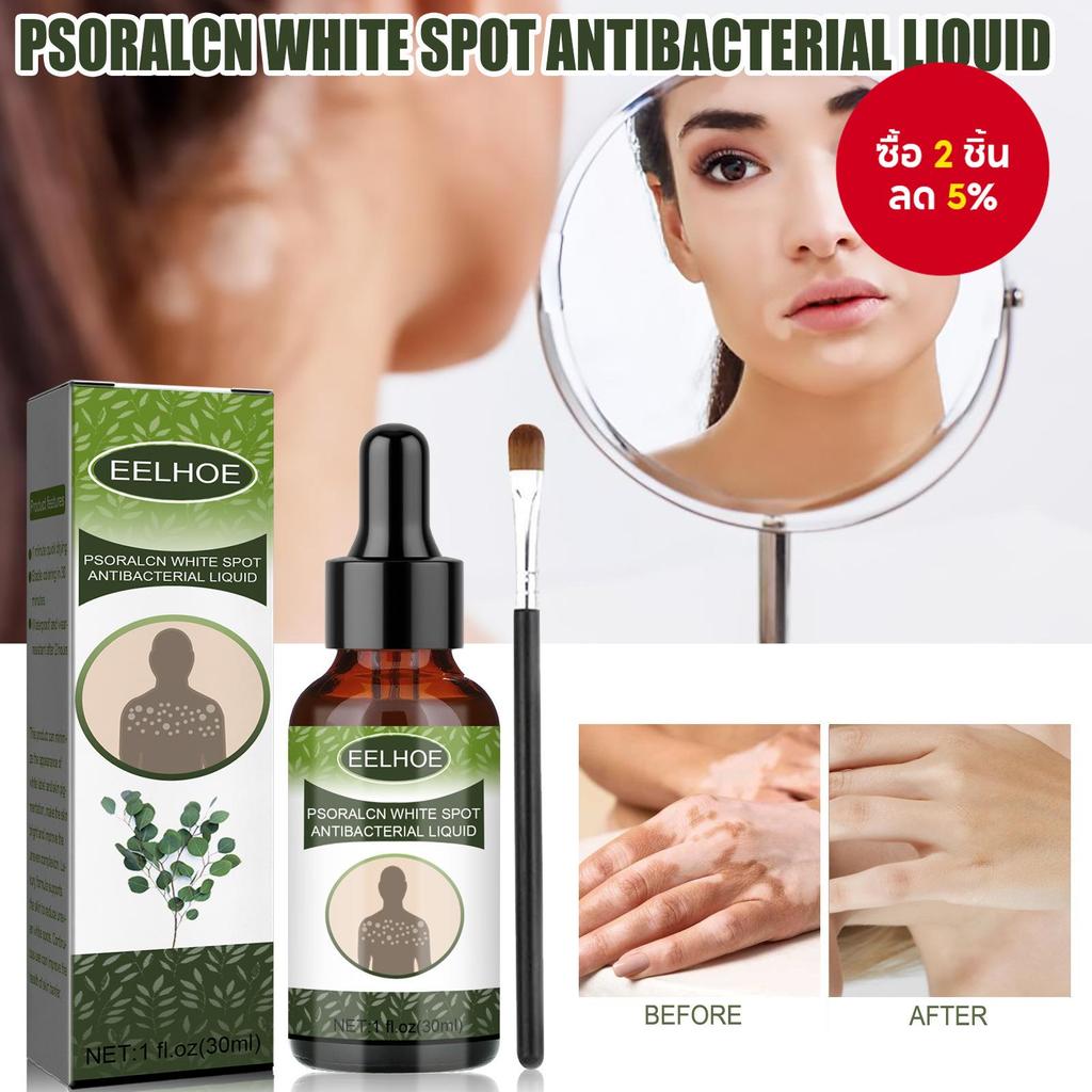 เซรั่มรักษาสะเก็ดเงิน – ช่วยปรับปรุงเม็ดสีผิว ลดจุดขาว กําจัดจุดด่างดําบนใบหน้าและร่างกาย สูตรฟื้นฟูสีผิว ขนาด 30 มล.