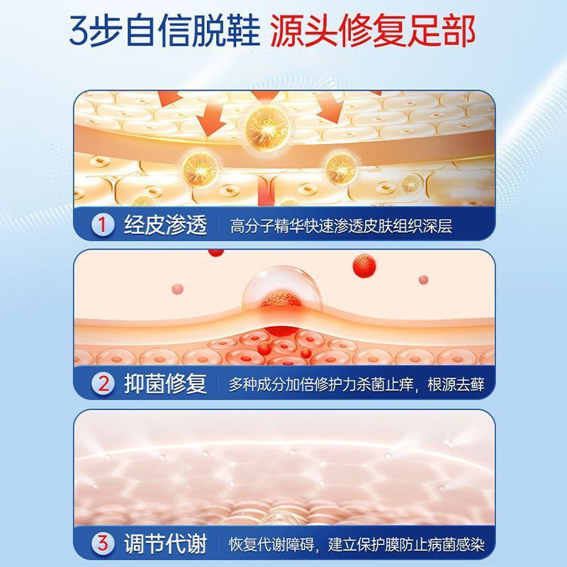 New Product#Russia Non-infectious fungal heel cracking, hard skin, keratotic athlete's foot, used to