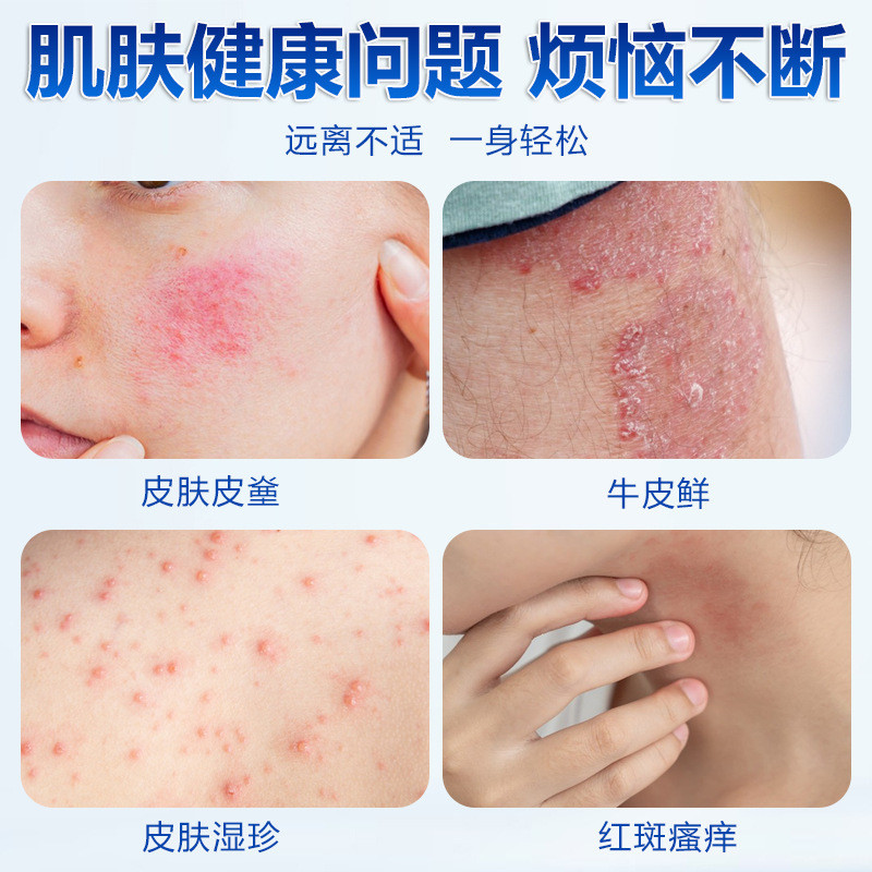 T Thailand Natas Wolf Venom Clean Cream สารสกัดจากสมุนไพรอาการคัน Stuborn Anti-อาการคันครีมอาการคันม