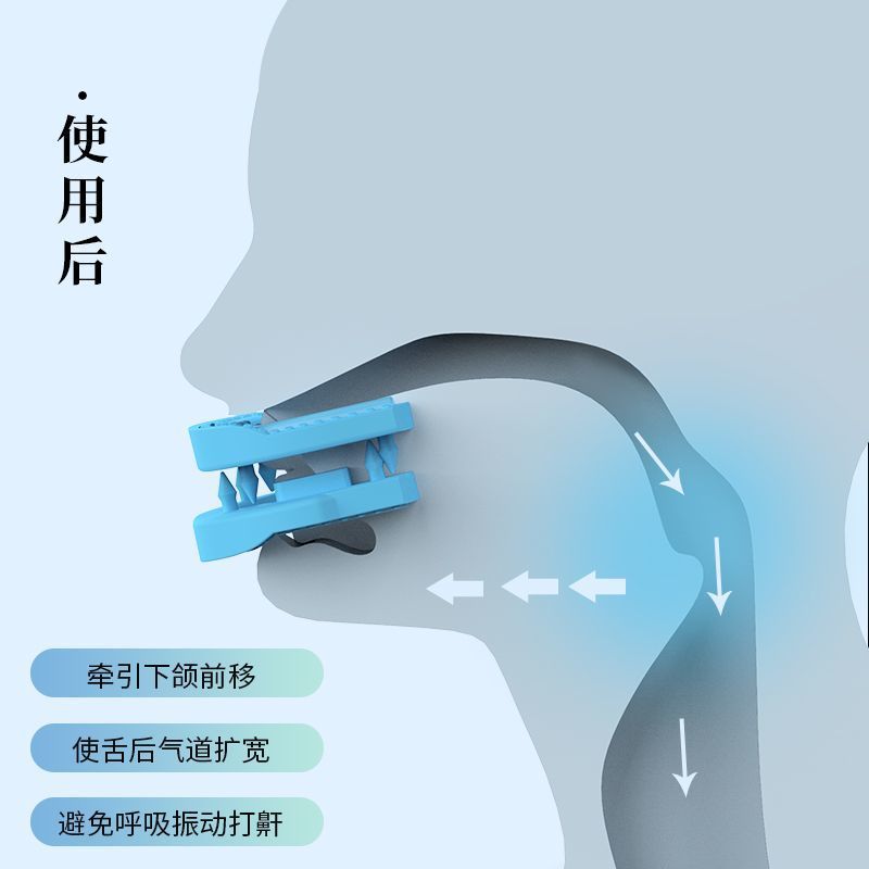 Anti-Snoring Braces Snoring Anti-Snoring Anti-Snoring Sleeping Molar ผู้ชายผู้หญิง Night Snoring อุป
