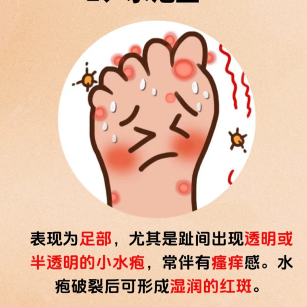 New Product#Compound essential oil for feet, effective in treating athlete's foot, foot odor, itchy 