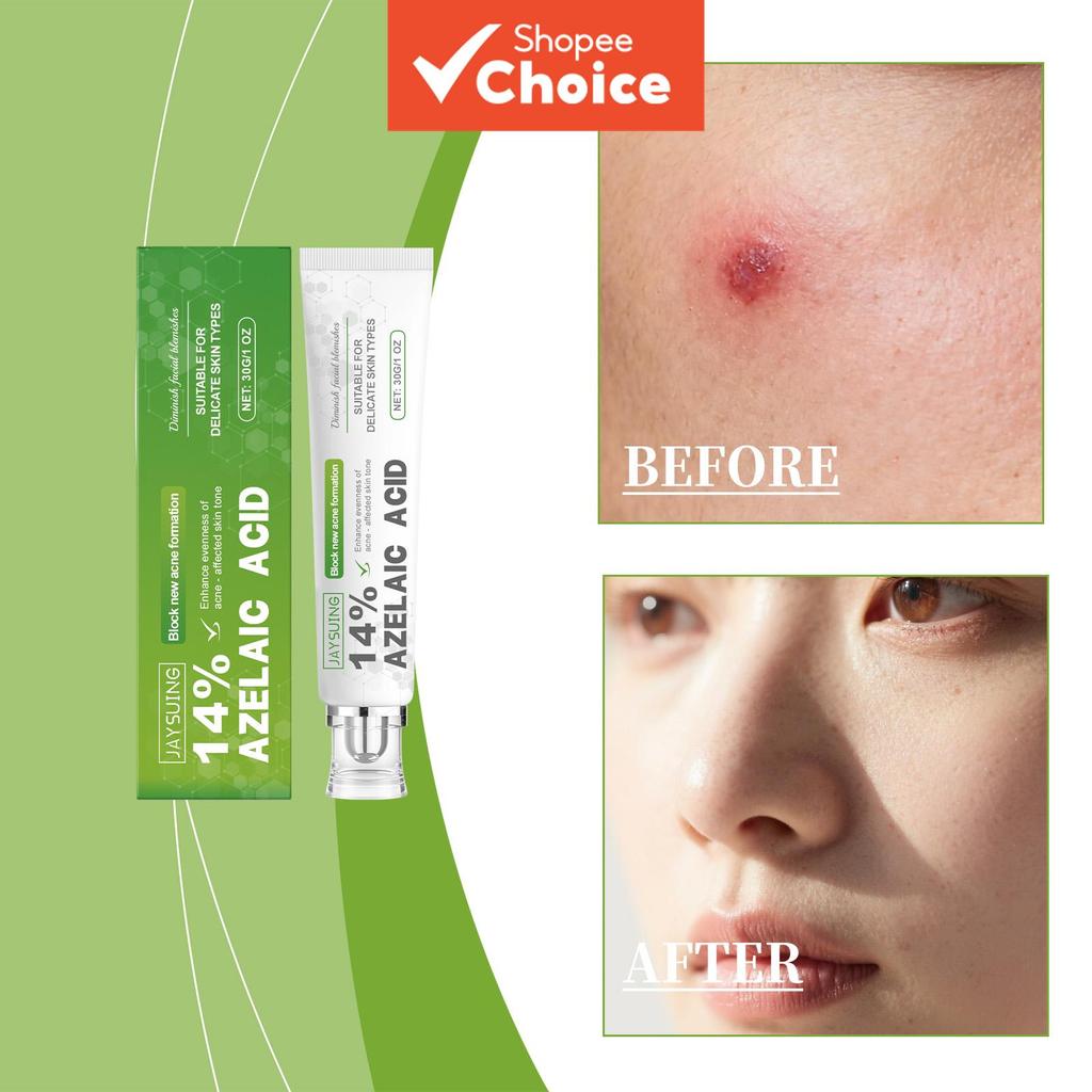กรดอะเซลาอิก 15% และครีมซาลิไซลิก 30 กรัม, ไฮยาลูรอนิกเพื่อบํารุงผิวสําหรับสิวและรอยสิว