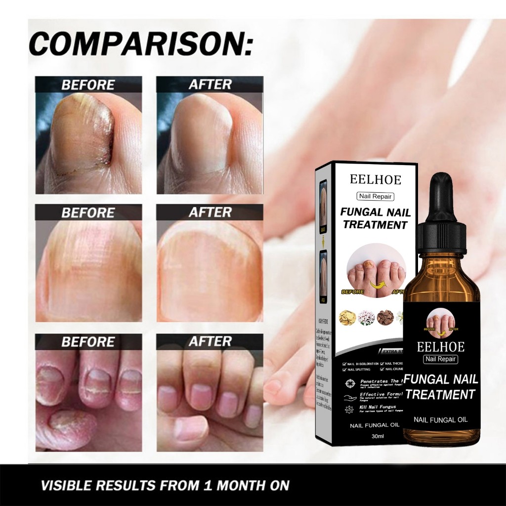 EELHOE 50ml น้ำยารักษาเชื้อราที่เล็บ น้ำยาซ่อมแซมเล็บเหลือง ซ่อมแซมเล็บแตก น้ำยารักษาเล็บ