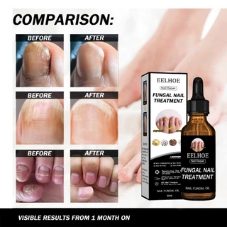 EELHOE 50ml น้ำยารักษาเชื้อราที่เล็บ น้ำยาซ่อมแซมเล็บเหลือง ซ่อมแซมเล็บแตก น้ำยารักษาเล็บ