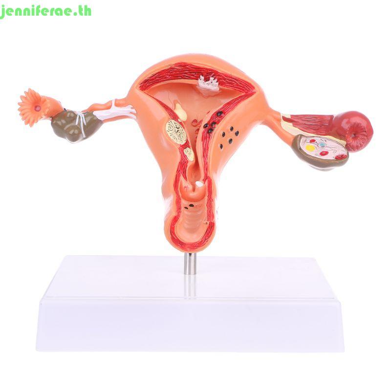 Jennifera มดลูกทางพยาธิวิทยา Ovary Anatomical รุ่น Anatomy สําหรับเครื่องมือศึกษาส่วนข้าม