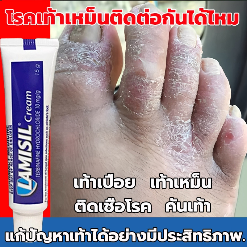 ครีมลดกลิ่นเท้า (ประสิทธิภาพดีเห็นผลเร็ว) แก้ปัญหาเท้าและขจัดกลิ่นเท้า – โปรปัง