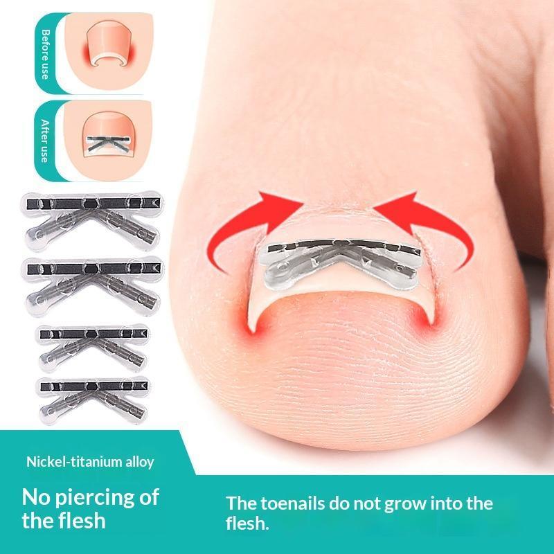 FLTH 2 ชิ้นคุด Toenail Corrector Pedicure กู้คืน Embed Toe Nail Treatment Professional คุด Toenail C