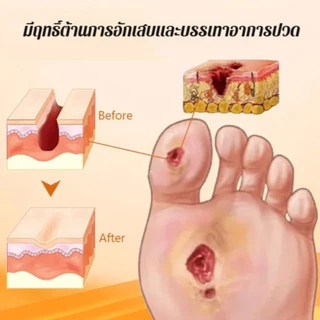 🔥สินค้าขายดี🔥 SL ครีมแผลเบาหวาน ฟื้นฟูแผลเร็ว ลดระดับน้ำตาล สำหรับผู้ป่วยเบาหวาน ของแท้💯