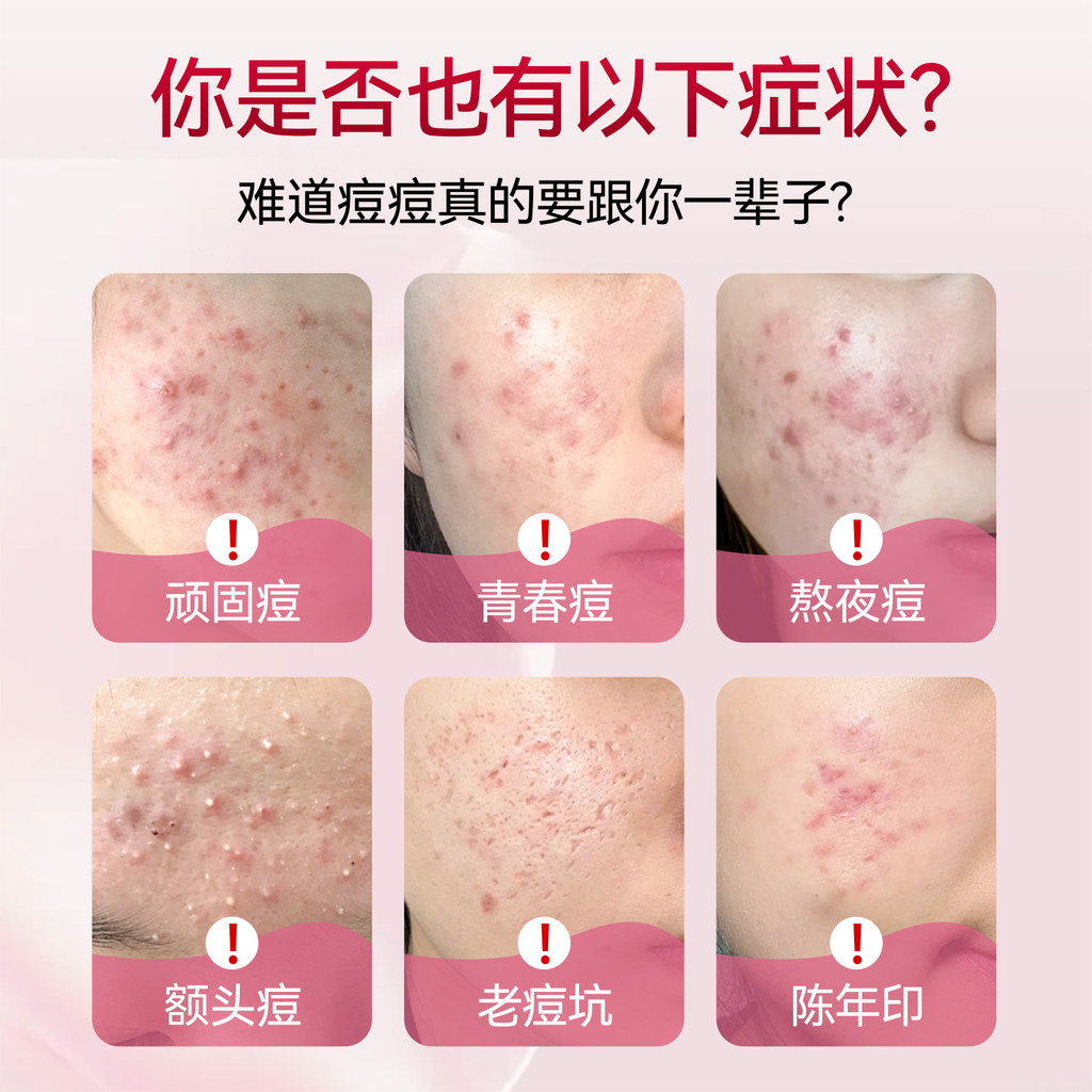 Yuxintang Ninghong ยี่ห้อ One Cup Granules ลบสิวสิว การปรับภายใน Beauty Beauty Nourishing Scrunchy H