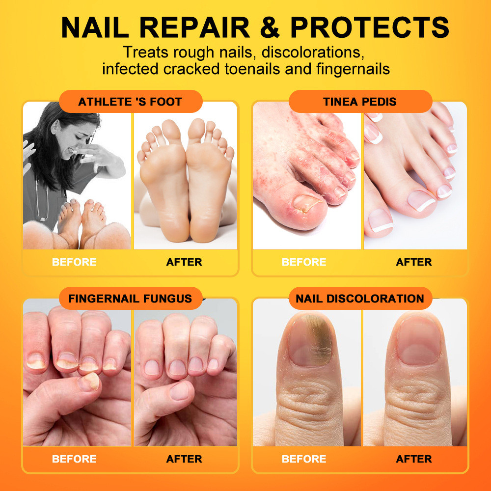 FFJ Bee Venom Foot Care Spray Onychomycosis กลิ่นเท้า 3 in 1 Care Spray V40002/12.20 Mango