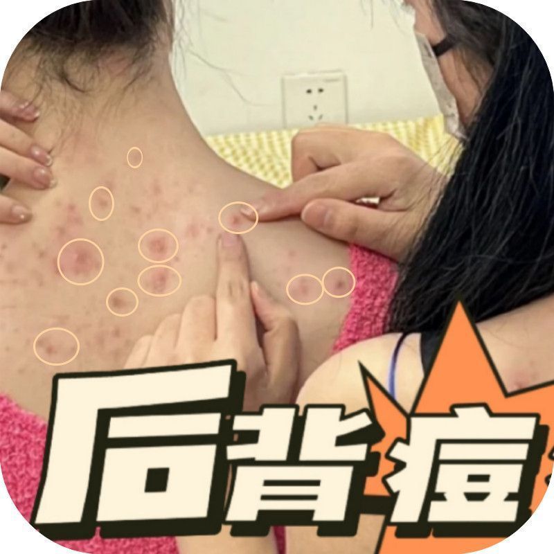 ครีมกําจัดสิวหลัง Hair Follicles Eczema ครีมพิเศษต้านเชื้อแบคทีเรีย yy4.21