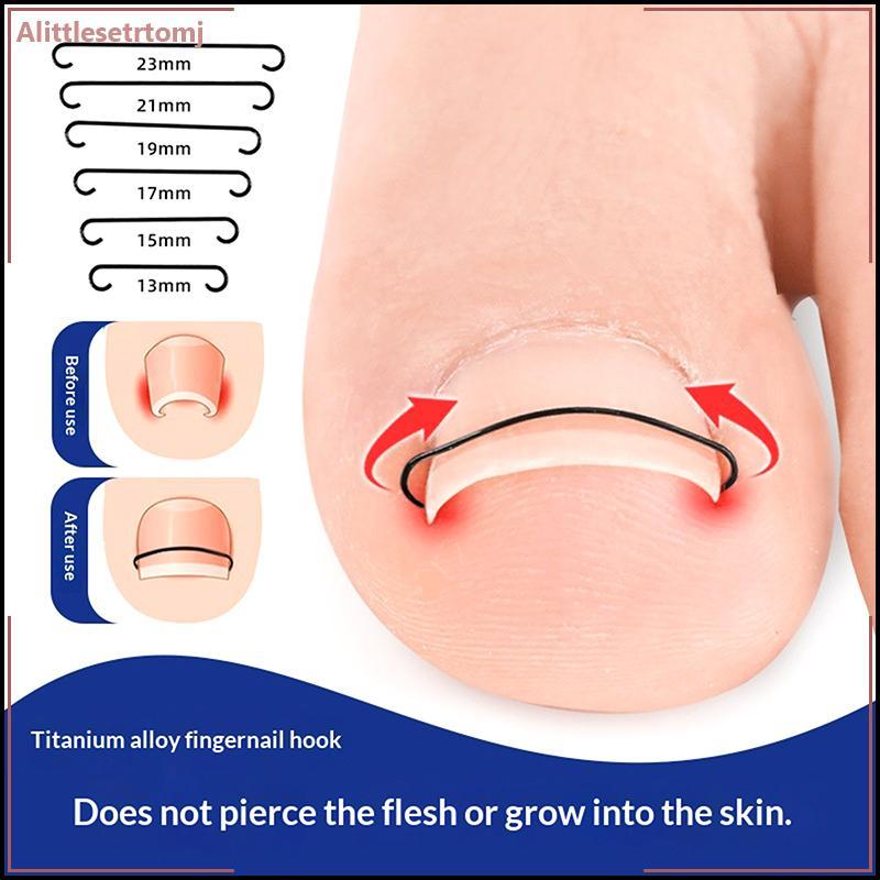 Alittlesetrtomj 2pcs คุด Toenail Corrector เครื่องมือ Pedicure กู้คืน Embed Toe Nail Treatment Profe