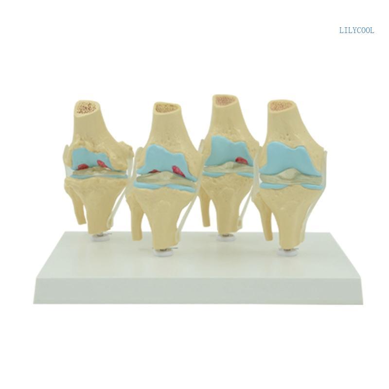 CH Life Size Human Degenerative Knee Joint Disease Model Medical Anatomy พร้อมฐานสําหรับห้องเรียนทาง
