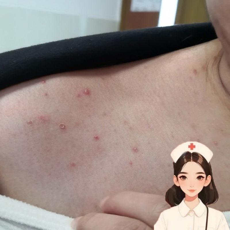 ครีมกําจัดสิวหลัง Hair Follicle Eczema ครีมต้านเชื้อแบคทีเรีย yy4.21