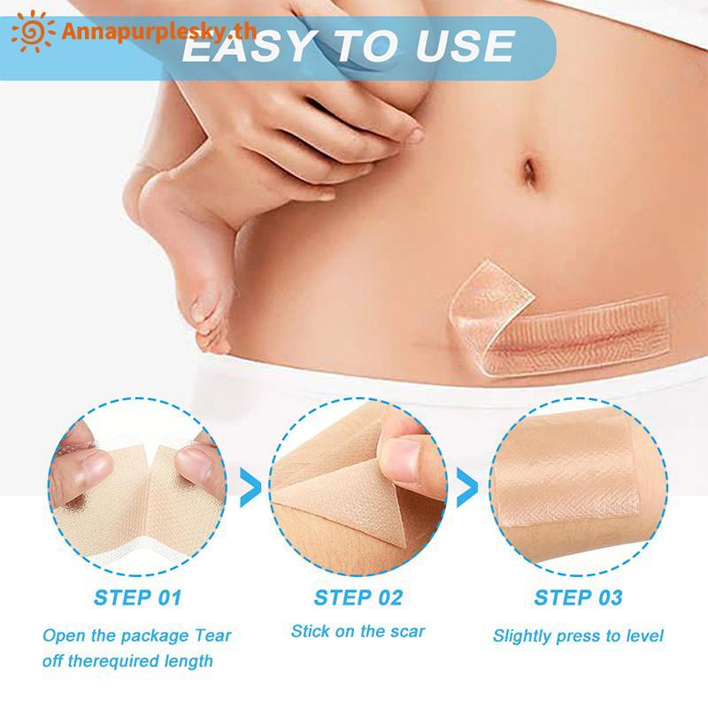 Annapursky Professional Silicone Scar Sheets แถบแบบใช้ซ้ําได้สําหรับ Keloid C-Section Burn Treatment