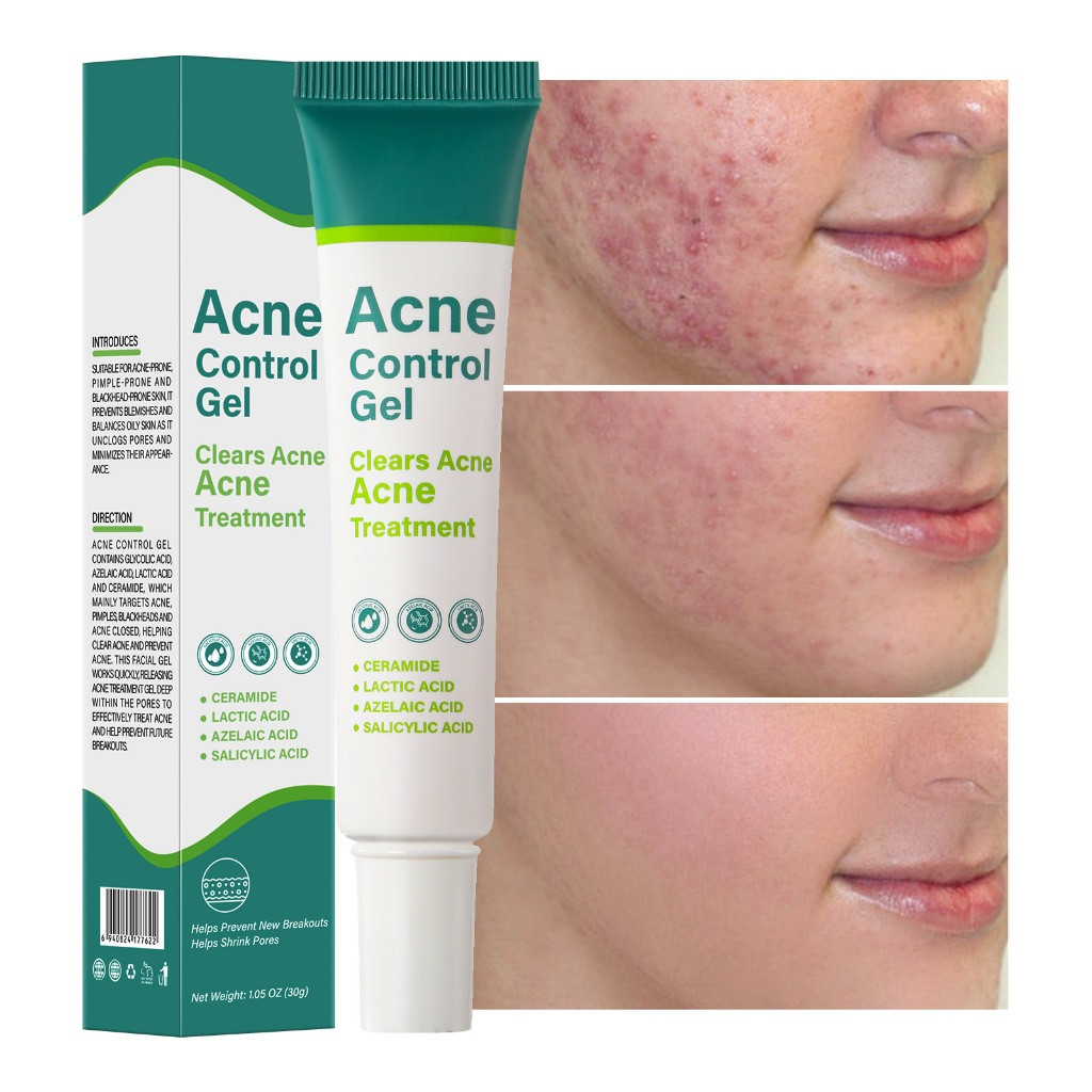 30g Acne Treatment Skin Cleanser Acne Remover Anti Acne Pimple Marks Remover