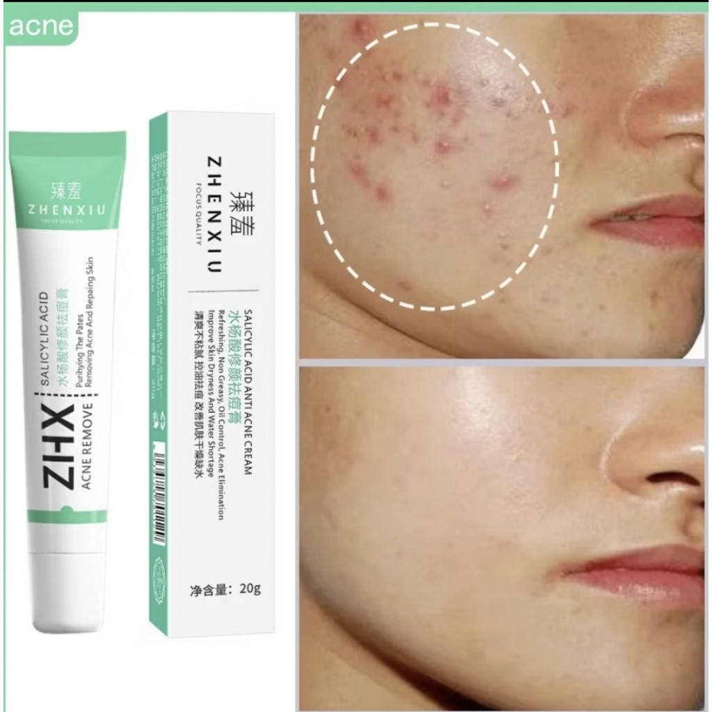 ZHENXIU ZHX ครีมป้องกันสิวพร้อมกรดซาลิไซลิกและสารสกัดจากธรรมชาติ 20g