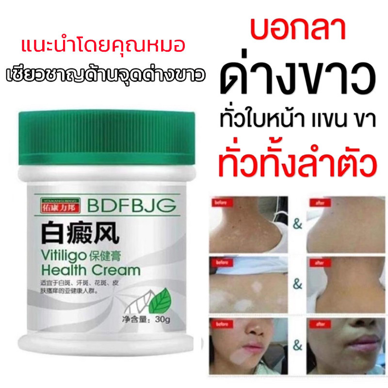 สมุนไพร ด่างขาว เกลื้อนน้ำนม ครีมบํารุงผิวรักษาจุดด่างดํา Vitiligo Health Cream รักษาด่างขาว ปรับสีผิวให้สม่ำเสมอ ของแท้