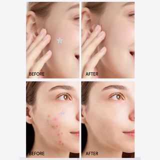 YTL ( มีส่งด่วน )แผ่นแปะสิว รูปดาว 200 ชิ้น PIMPLES PATCH แผ่นแปะสิวปกปิดรอยสิว