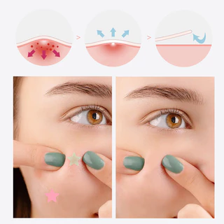 YTL ( มีส่งด่วน )แผ่นแปะสิว รูปดาว 200 ชิ้น PIMPLES PATCH แผ่นแปะสิวปกปิดรอยสิว