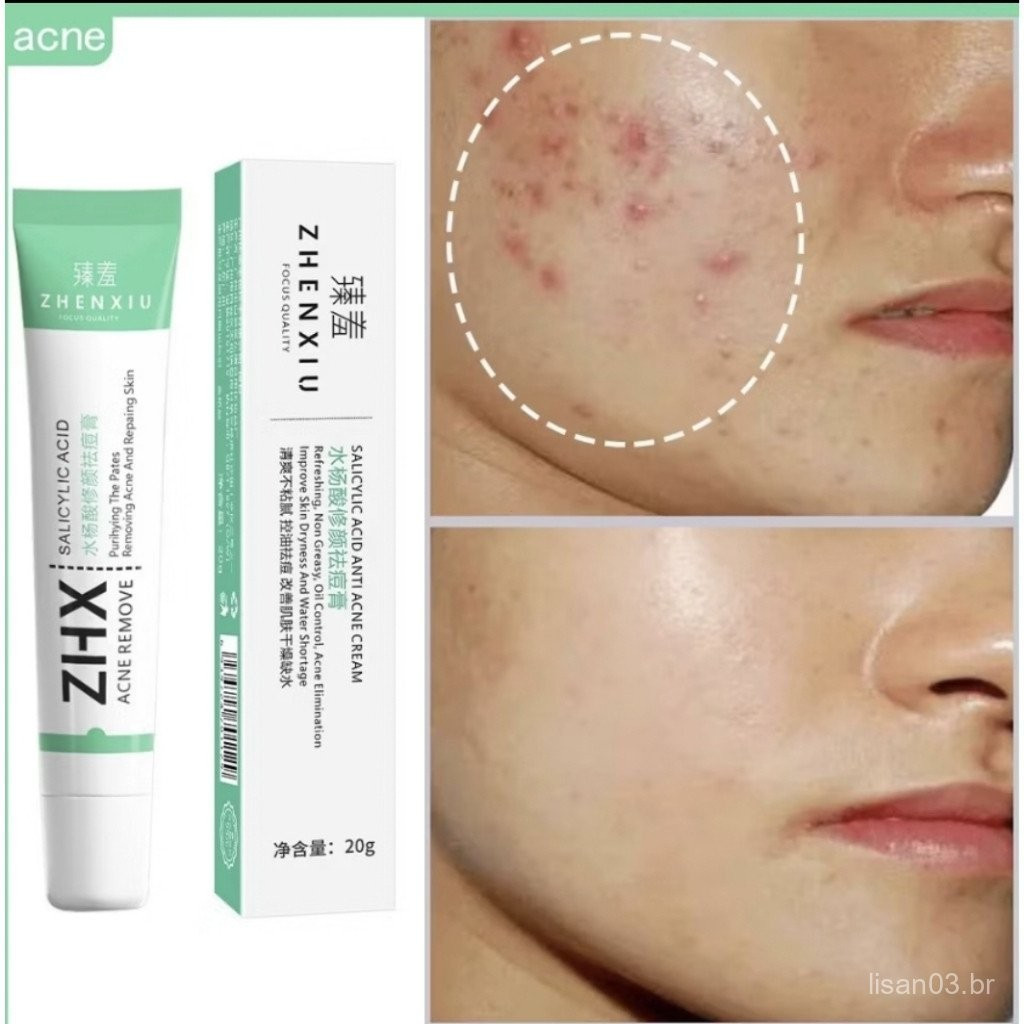 ZHENXIU ZHX ครีมป้องกันสิวพร้อมกรดซาลิไซลิกและสารสกัดจากธรรมชาติ 20g
