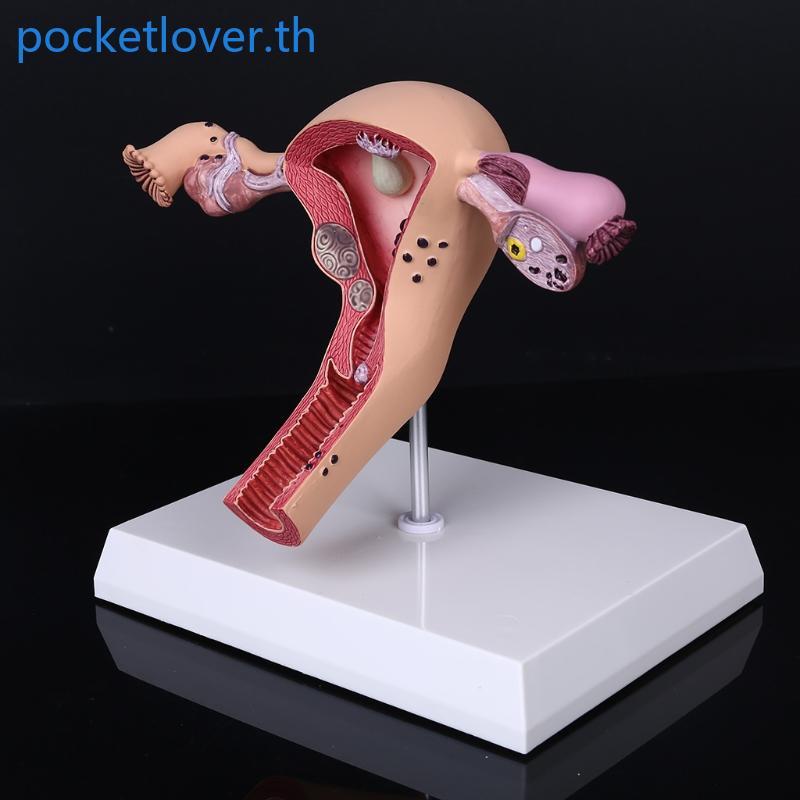Poc Human Female Uterus Ovary Disection Pathology Model ชีววิทยาการสอน