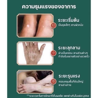 ครีมทาด่างขาว 30gสารสกัดจากสมุนไพร ด่างขาวที่หน้า ด่างขาวที่หลัง ด่างขาวที่แขน ด่างขาวที่ขา โรคผิวหนัง Vitiligo ยาทาด่า