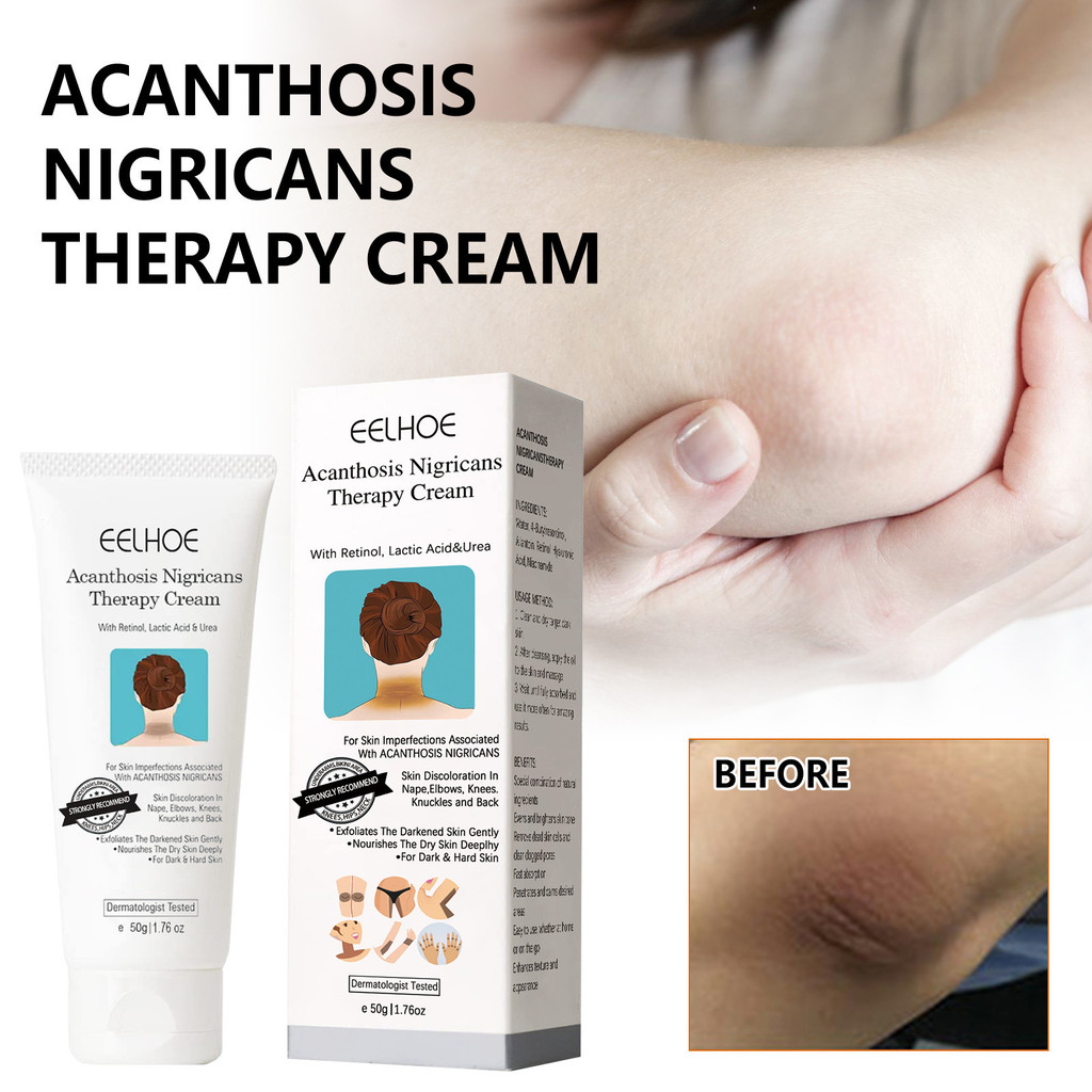 EELHOE Black Acacia Skin Repair Cream Moisturizing Whitening Repair Arm รักแร้เข่า Joint Black Body 