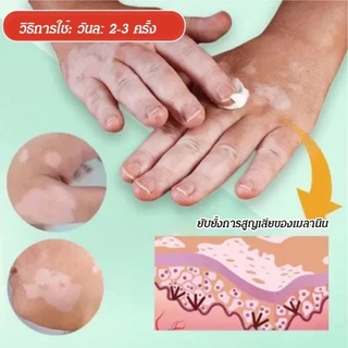 ครีมทาด่างขาว 30gสารสกัดจากสมุนไพร ด่างขาวที่หน้า ด่างขาวที่หลัง ด่างขาวที่แขน ด่างขาวที่ขา โรคผิวหนัง Vitiligo ยาทาด่า