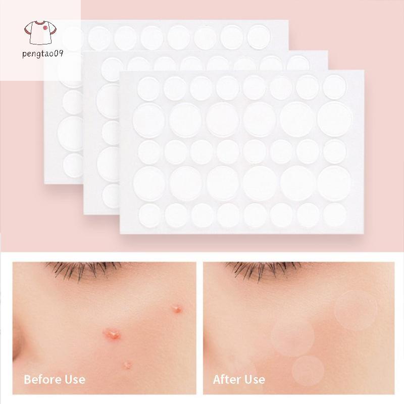 Pengatao09 สิว Pimple Patch สติกเกอร์ Pimple Remover เครื่องมือดูดซับ Pus และ Oil Acne Patch ใหม่