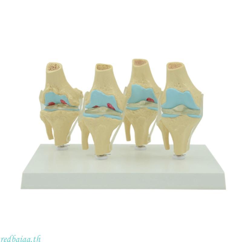 Redbaiaa ยืดหยุ่น Human Knee Joint Anatomy รุ่น Comparison of Knee Joint รุ่นชีวิตขนาด