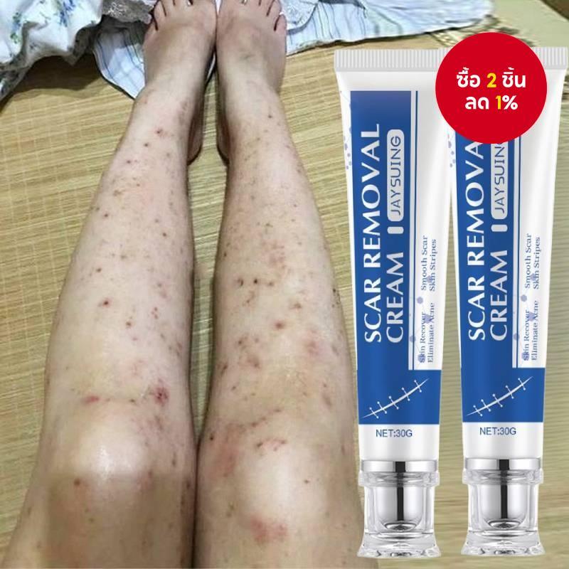 【ซื้อ 1 แถม 1】ครีมลบแผลเป็นเก่า รักษาแผลเป็นที่ขา ครีมซ่อมแซมรอยแตกลาย การรักษาสิว และการซ่อมแผลเป็น