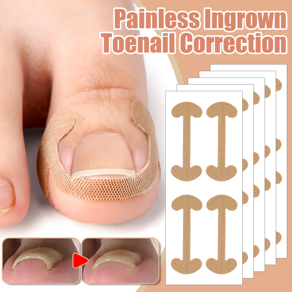20/100 ชิ้น Professional คุด Toenail Correction สติกเกอร์เท้าเล็บ Corrector Toe Pad Pedicure Health Care เครื่องมือ